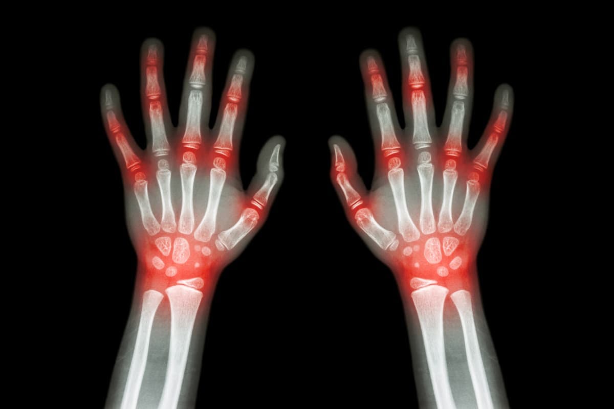 Arthritis in hands - stockdevil - stock.adobe.com