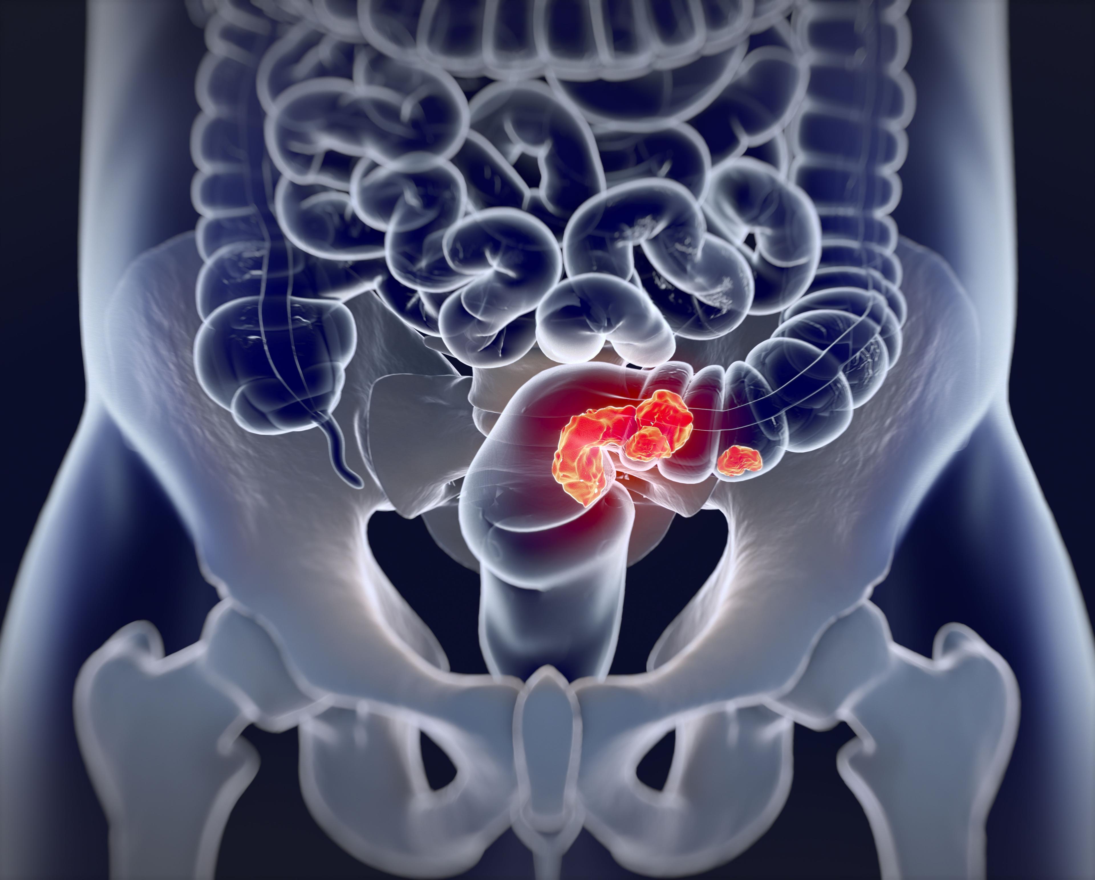 Radiotherapy can affect quality of life in patients receiving surgery for rectal cancer | Image credit: Anatomy Insider - stock.adobe.com