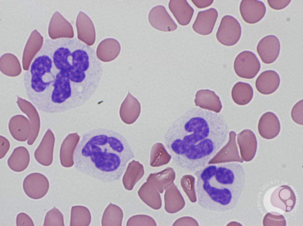 Myeloproliferative neoplasms have drawn interest from researchers as candidates for therapeutic vaccines | Image credit: © Ruimin Li; Xiaoqiang Lian for ASH Image Bank