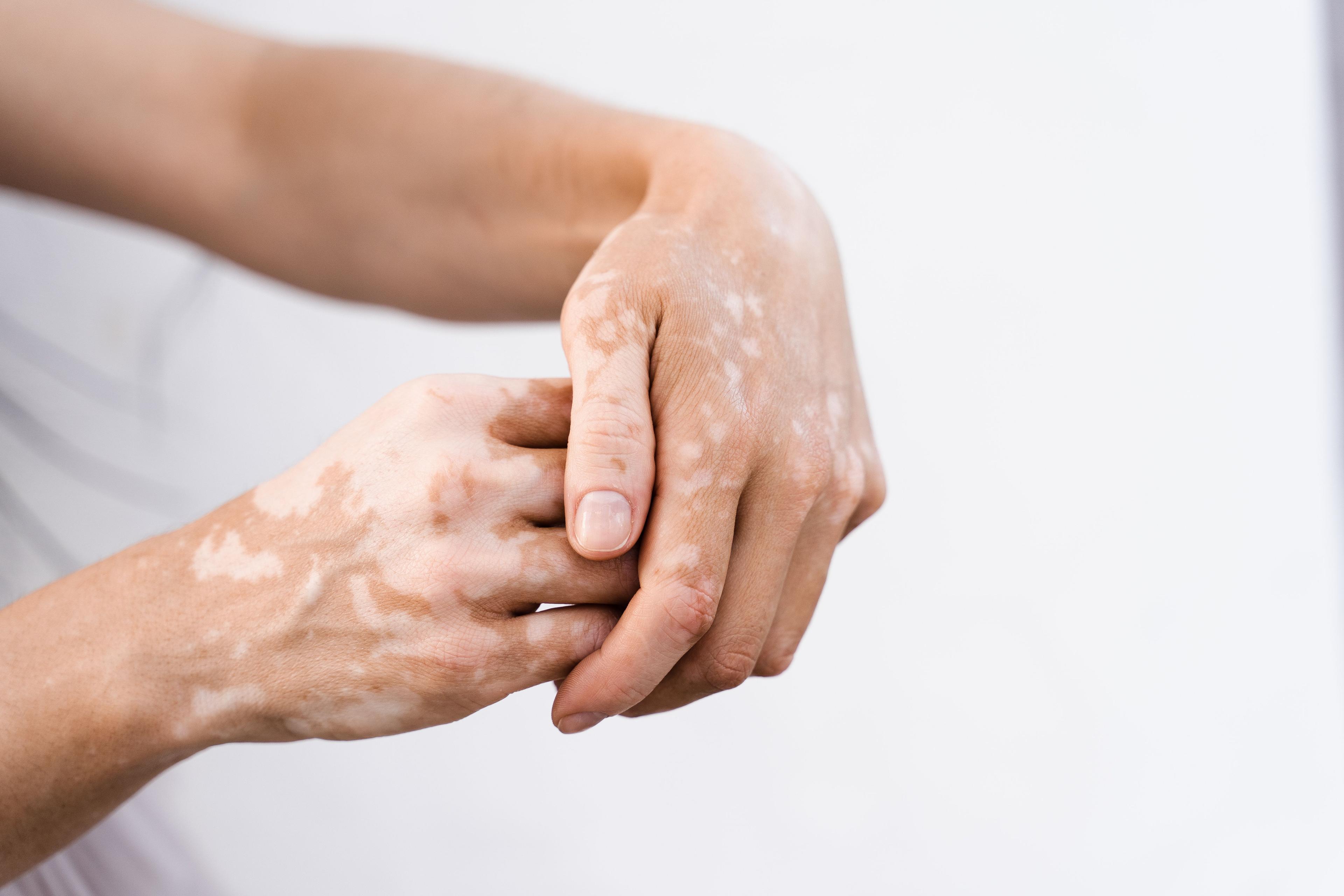 hands of a patient with vitiligo | Image Credit: Rabizo Anatolii - stock.adobe.com