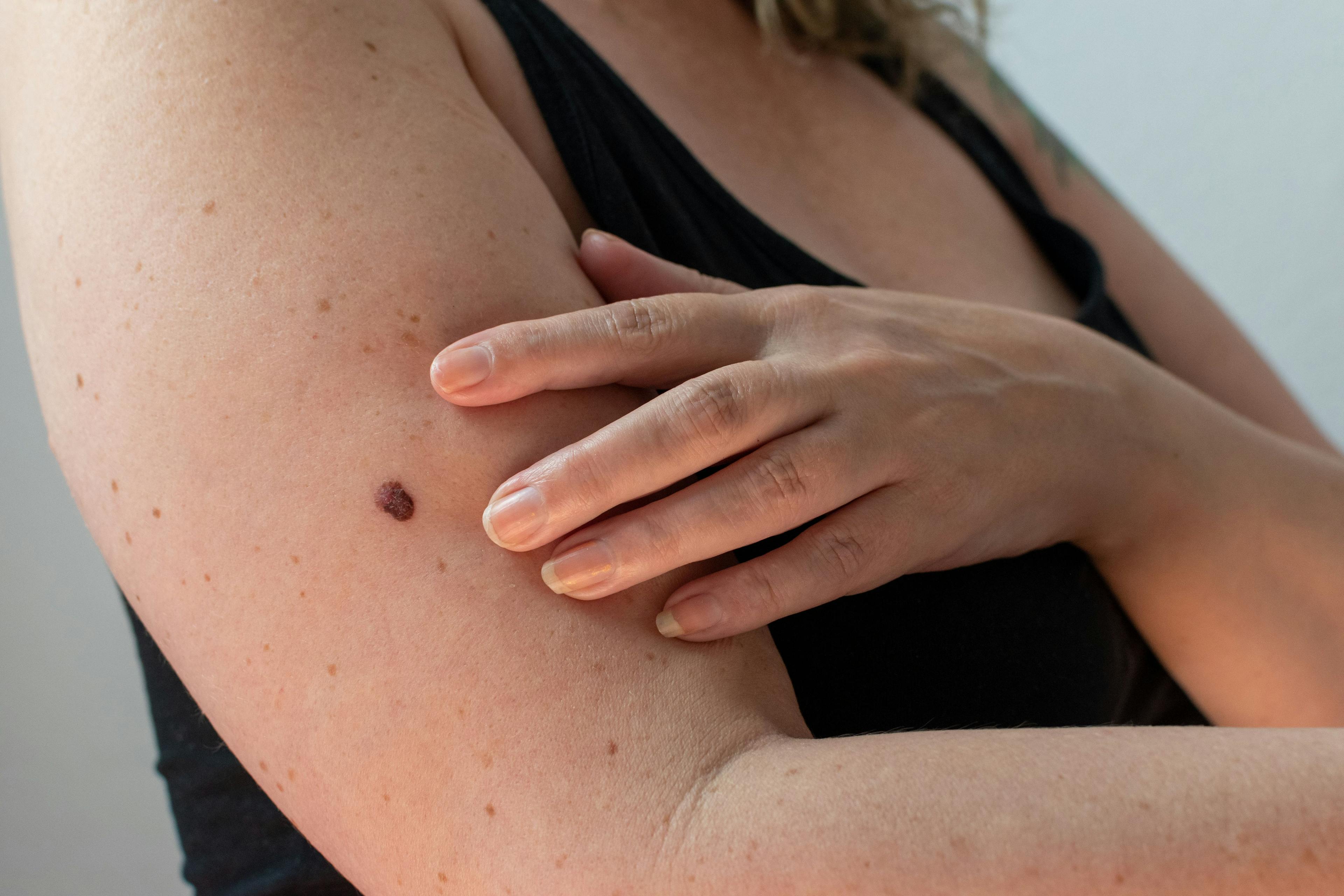 Woman checking her skin for signs of melanoma | Image credit: MW Photography - stock.adobe.com