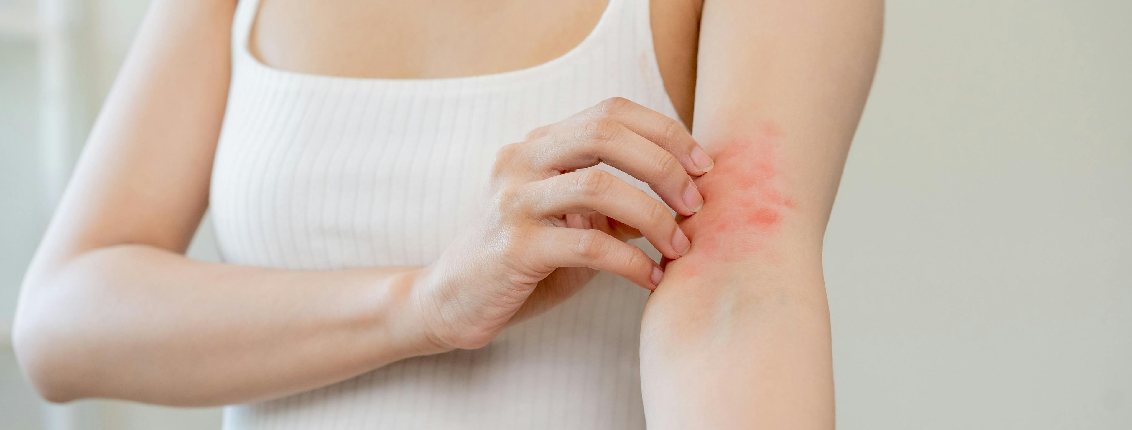 Female patient scratching atopic dermatitis (AD) | Image Credit: KMPZZZ - stock.adobe.com