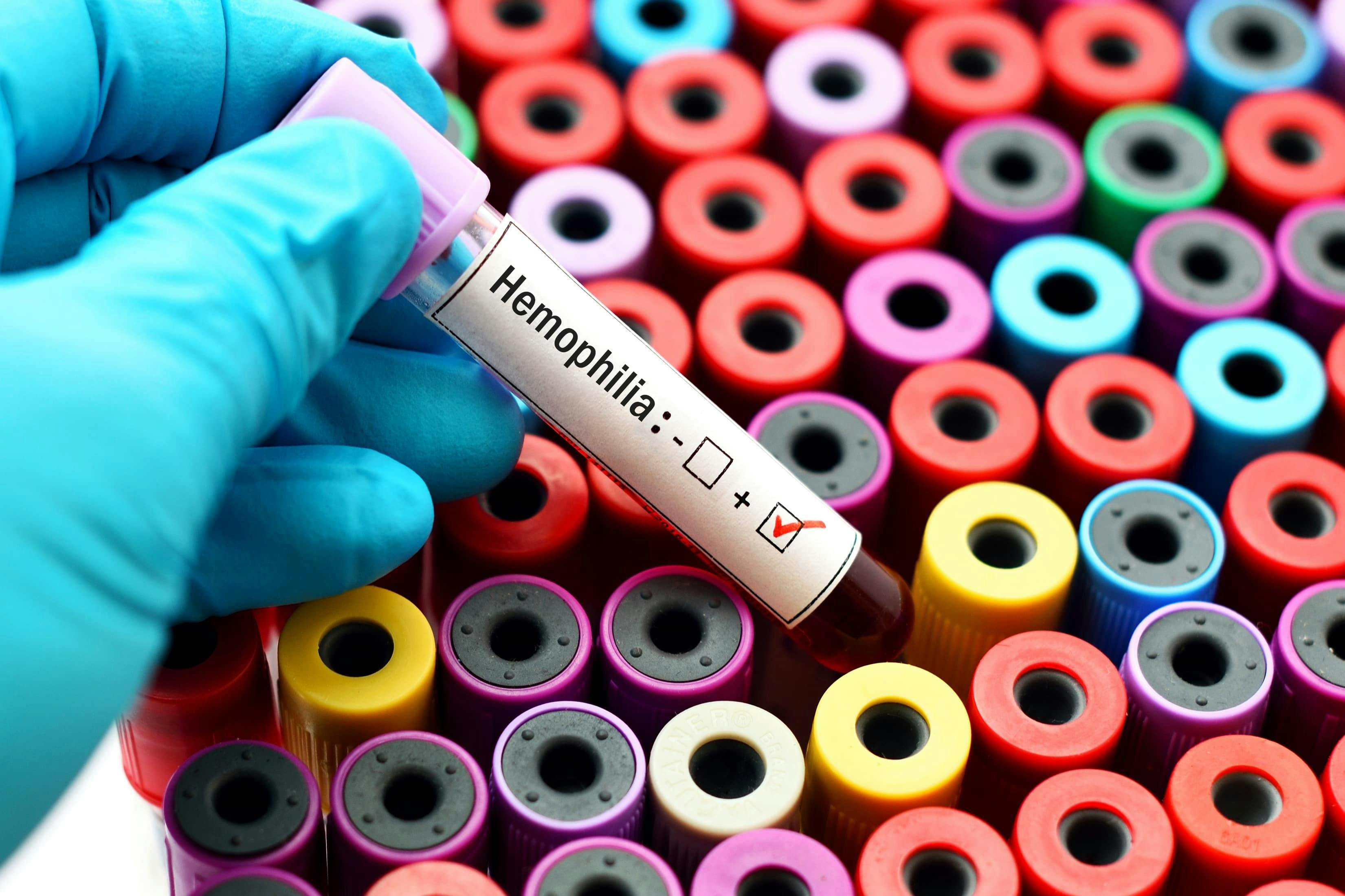 picture of tubes of blood labels with the word hemeophilia