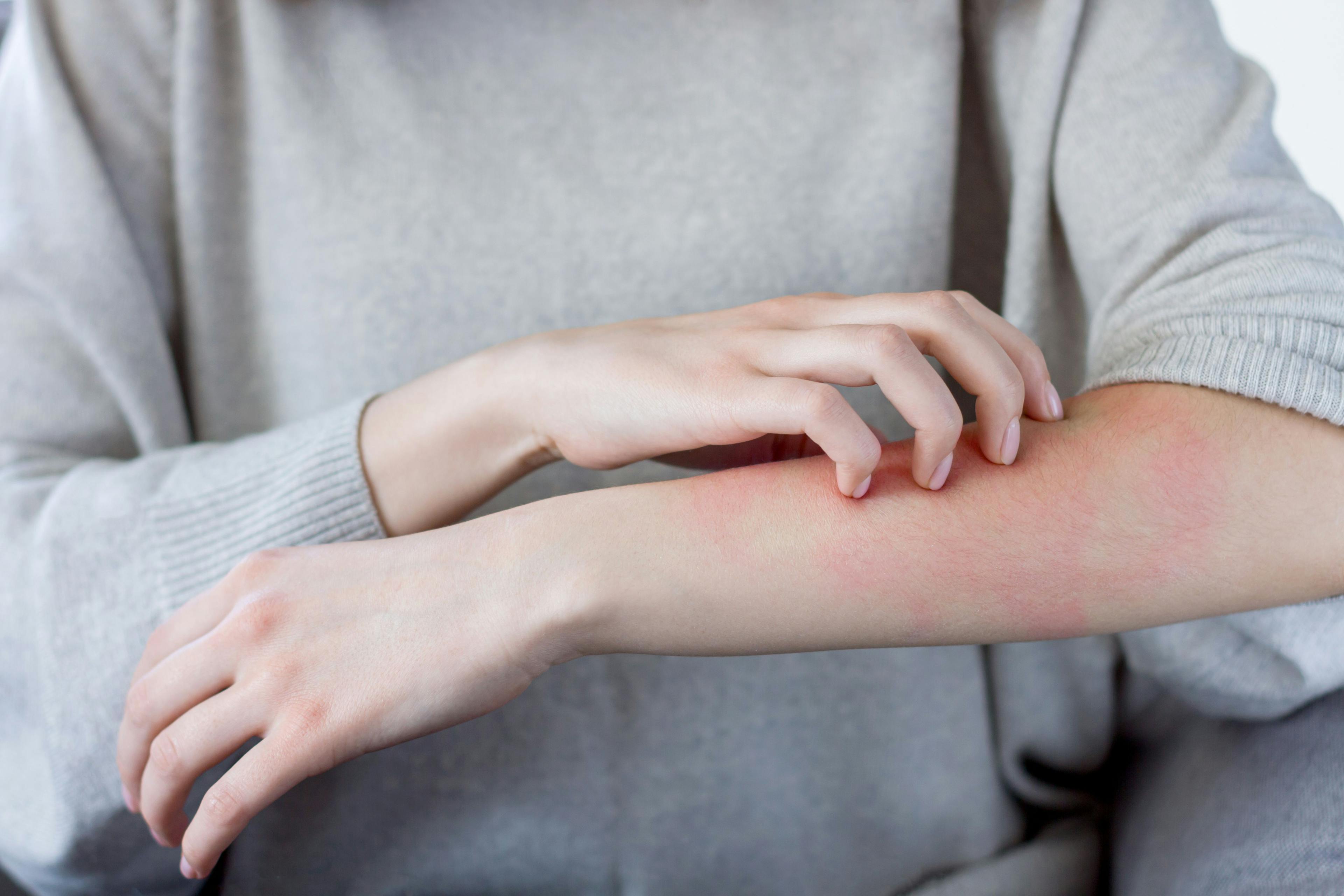 Woman scratching skin | Image credit: Monstar Studio - stock.adobe.com