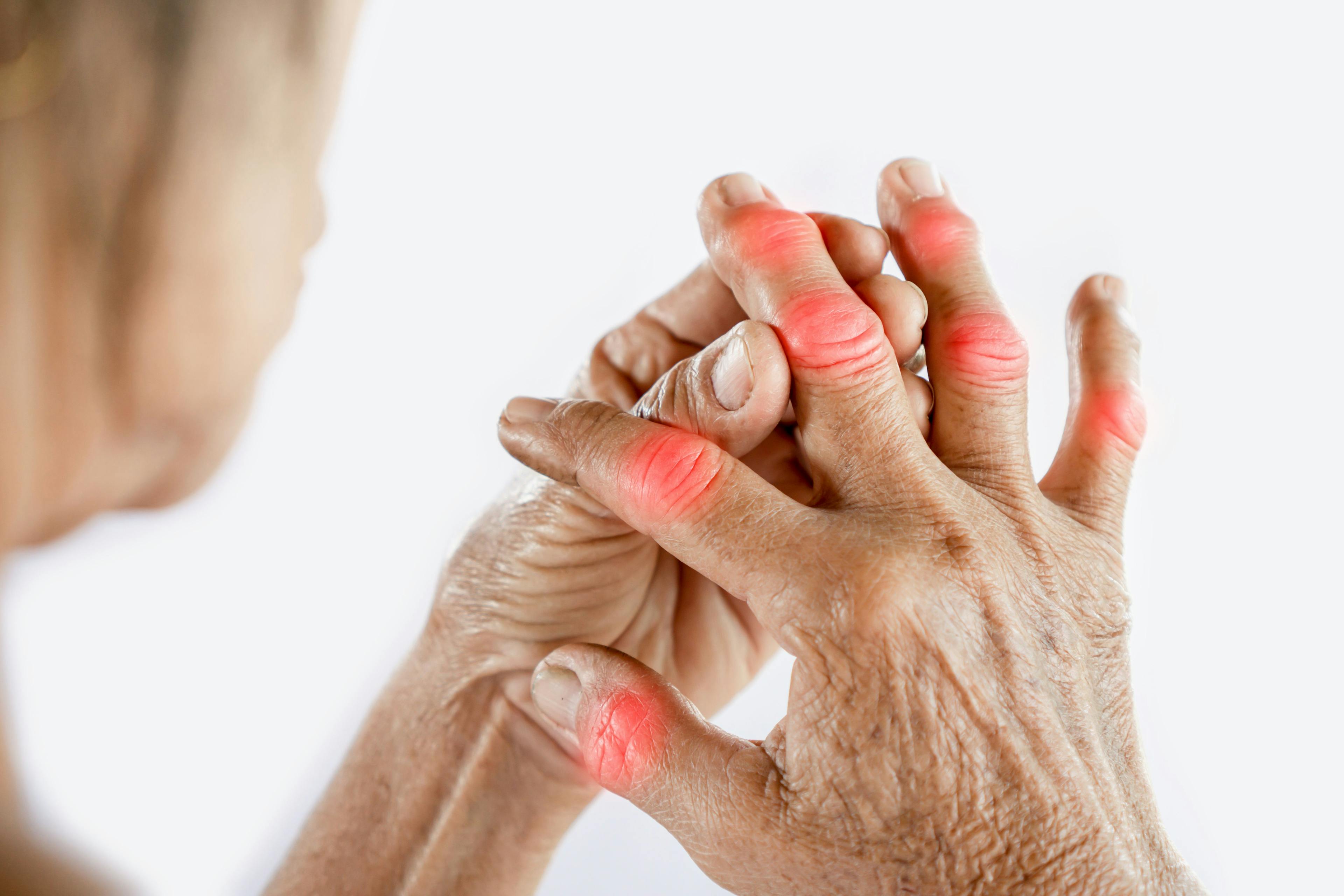 Woman Enduring Rheumatoid Arthritis | image credit: doucefleur - stock.adobe.com
