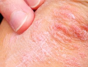 5 Things About Psoriasis and Its Complications