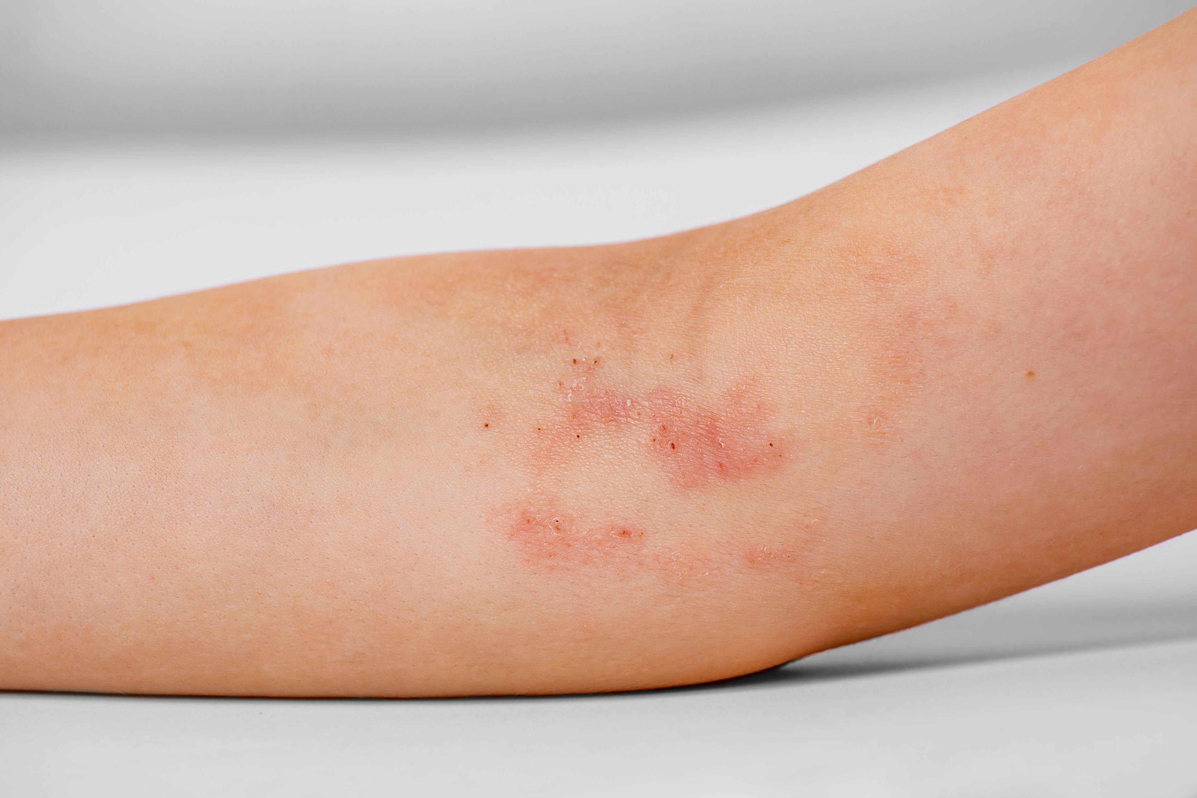 Atopic Dermatitis on Child's Arm | image credit: arhat - stock.adobe.com