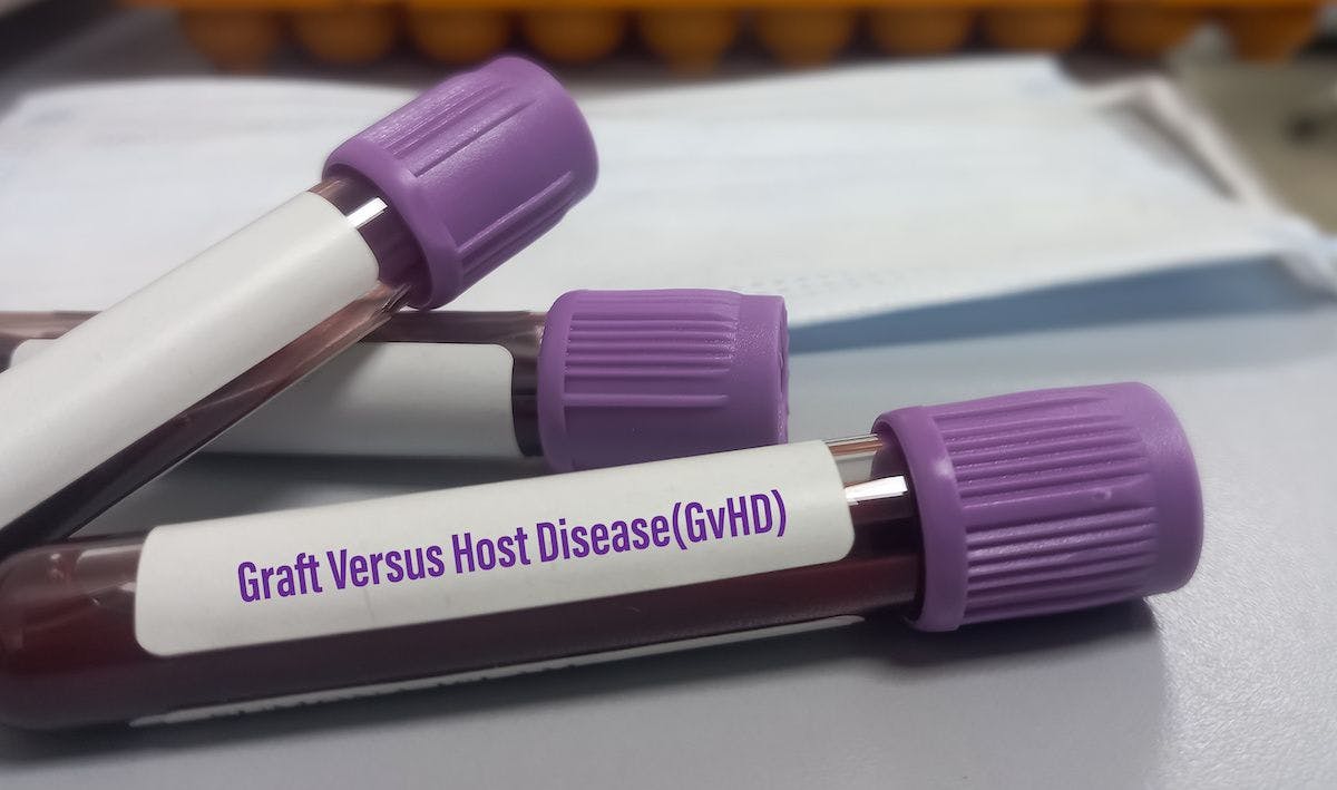 GVHD graft vs host disease blood sample | Image Credit: © MdBabul - stock.adobe.com