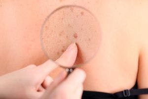 FDA Approves Libtayo to Treat Second Most Common Skin Cancer