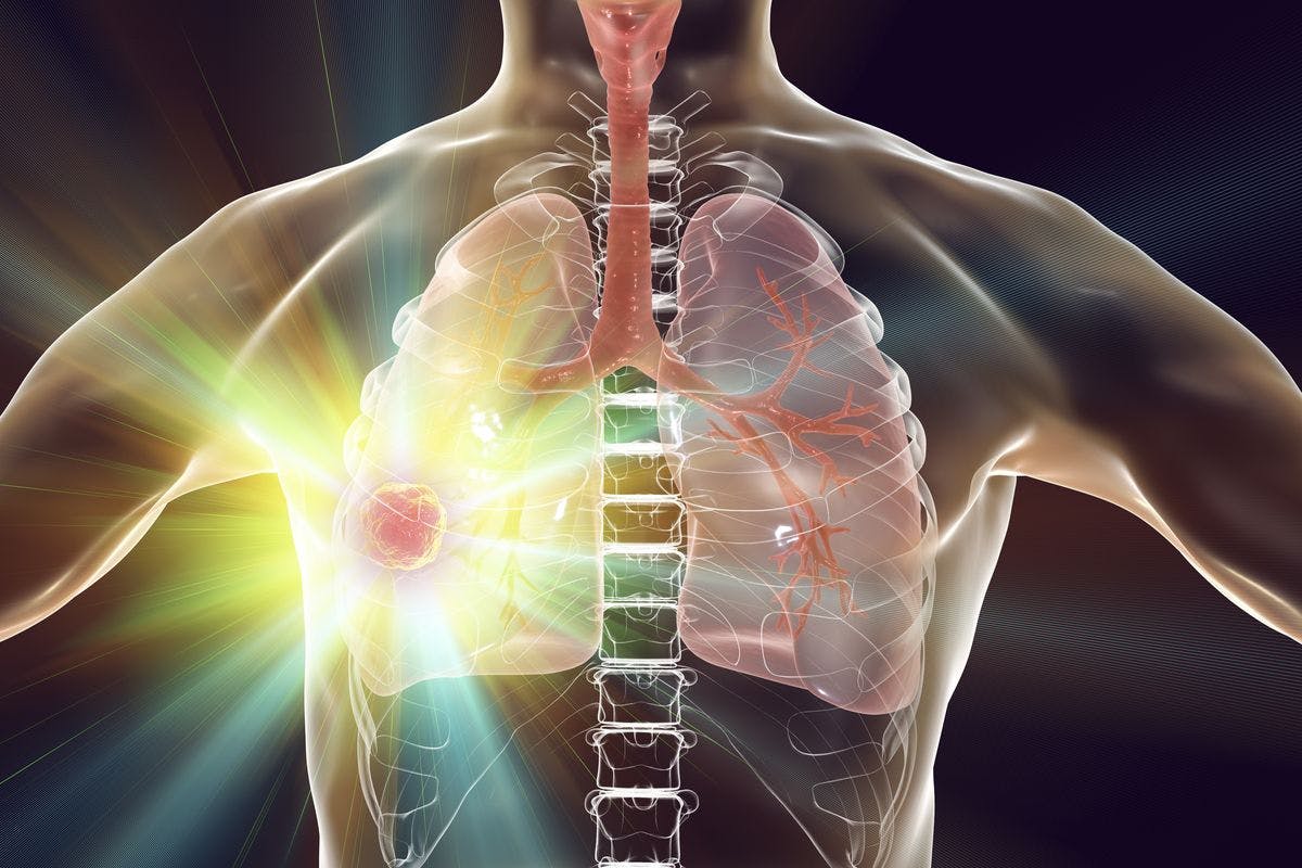 TTFields With SOC Shows Clinically Meaningful Overall Survival Improvement in Metastatic NSCLC