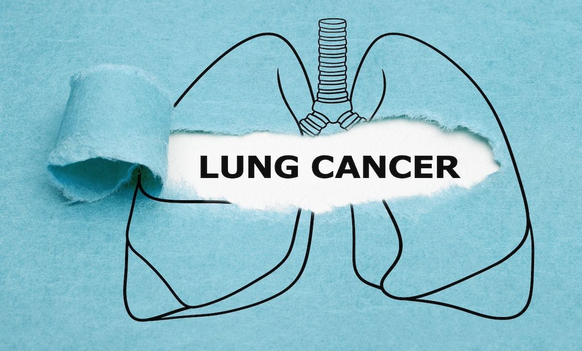 Lung cancer concept | Image Credit: ivelinradkov - stock.adoe.com