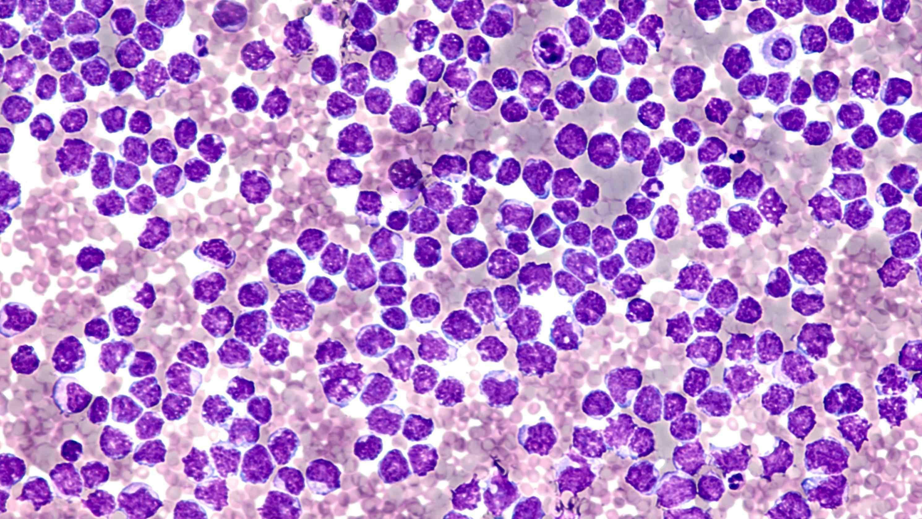 Mantle cell lymphoma Image credit: David A Litman - stock.adobe.com