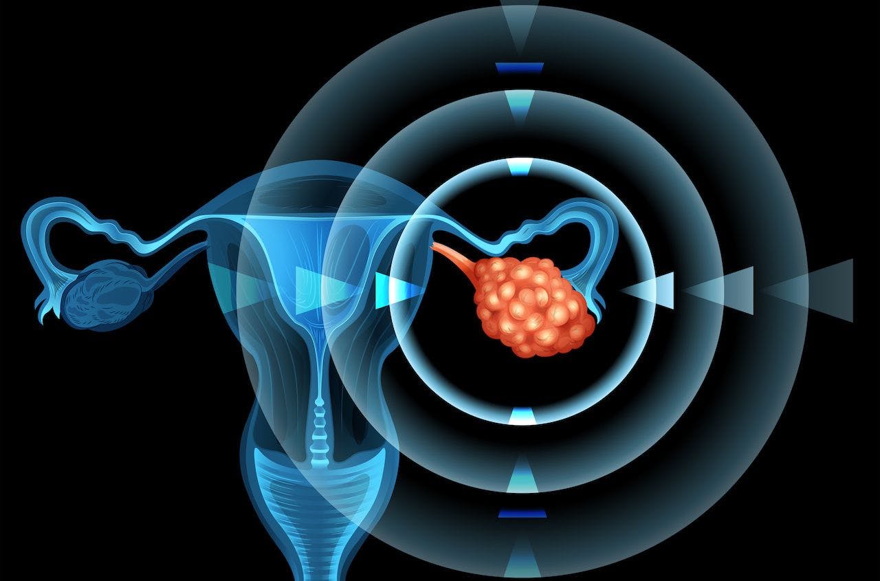 ovarian cancer circled | blueringmedia - stock.adobe.com
