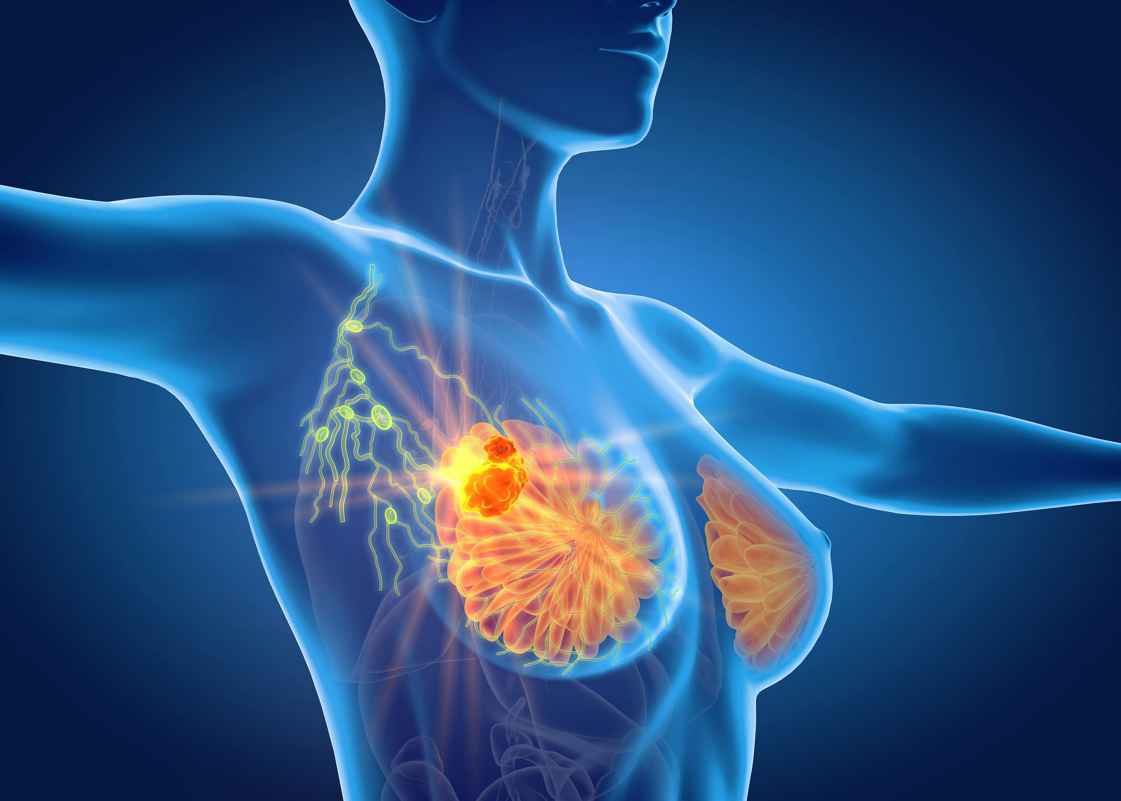 Breast cancer with lymphatics | Image Credit: Axel Kock - stock.adobe.com
