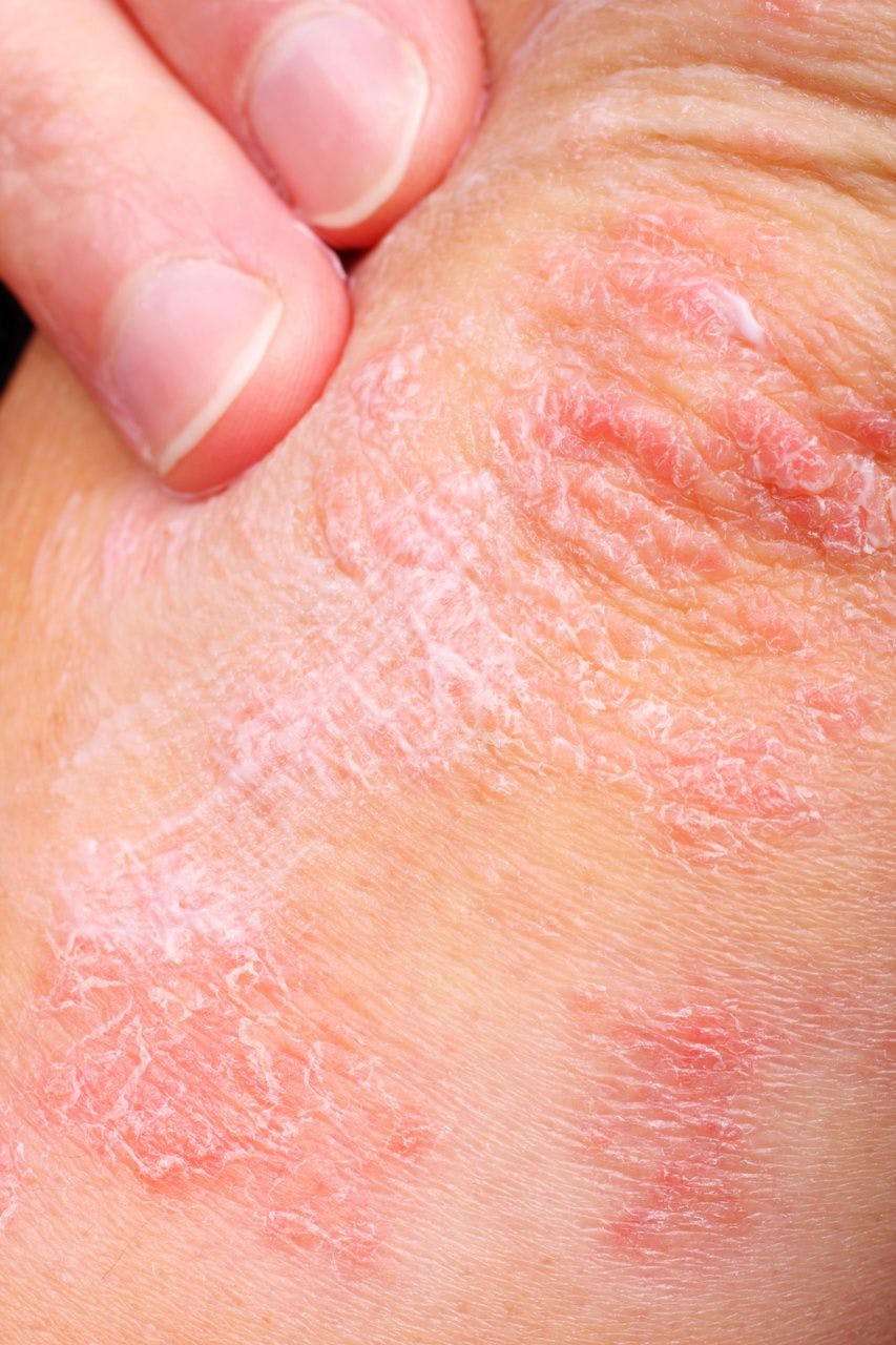 Immune Checkpoint Inhibitors Linked With Psoriasis Flare-ups in Rare Cases