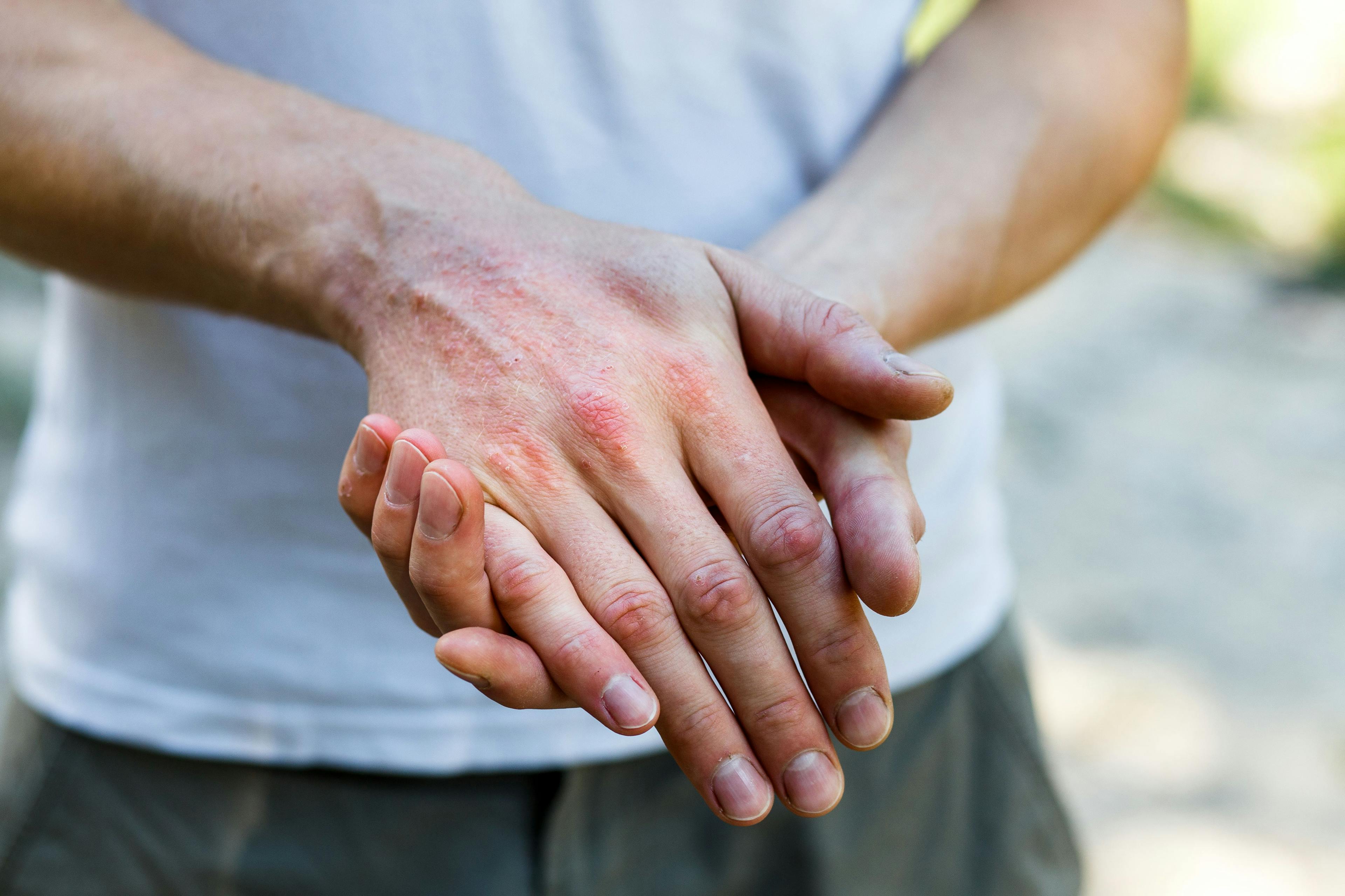 man's hands with atopic dermatitis | Image Credit: Ольга Тернавская - stock.adobe.com