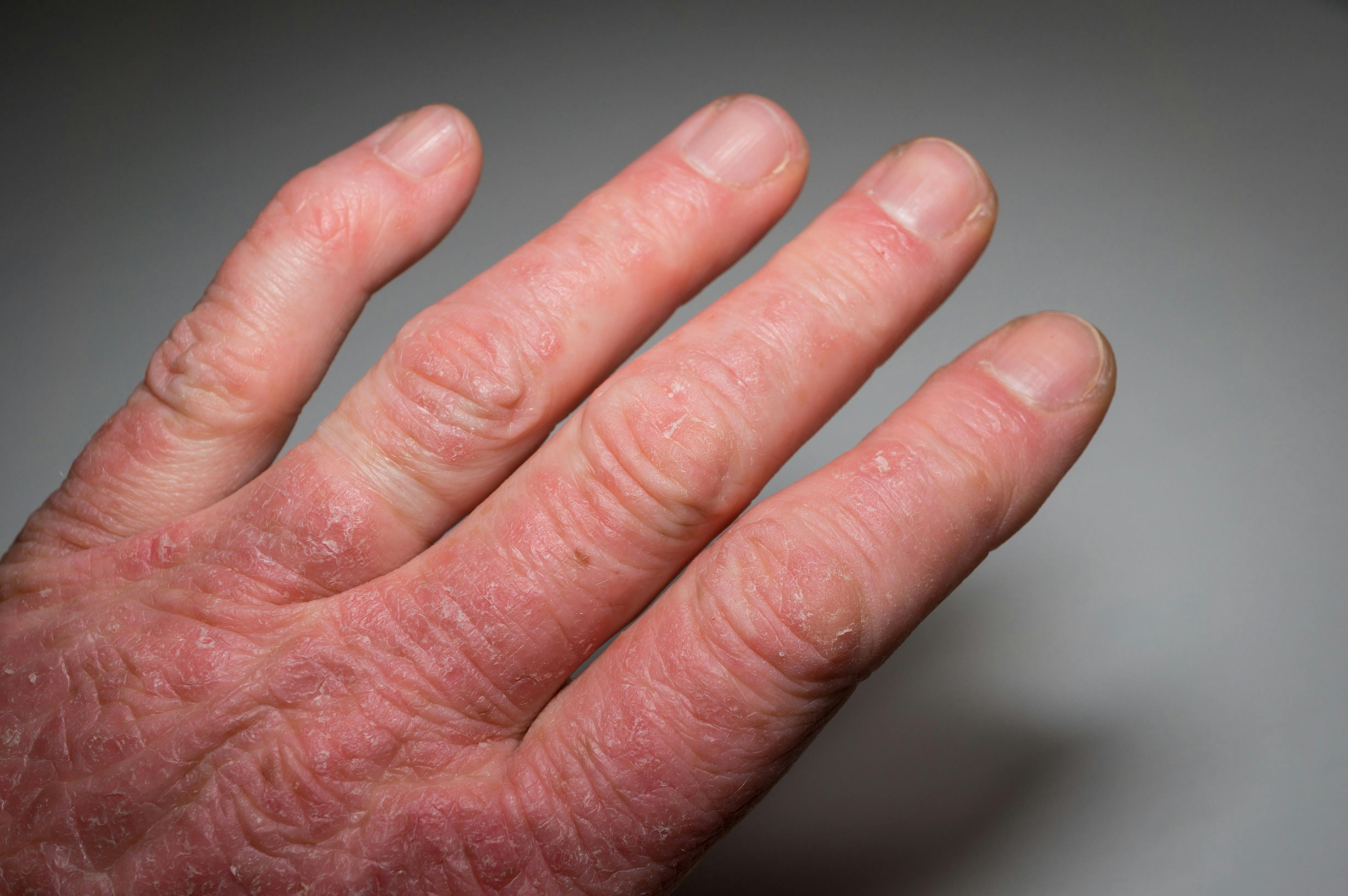 Hand with psoriasis