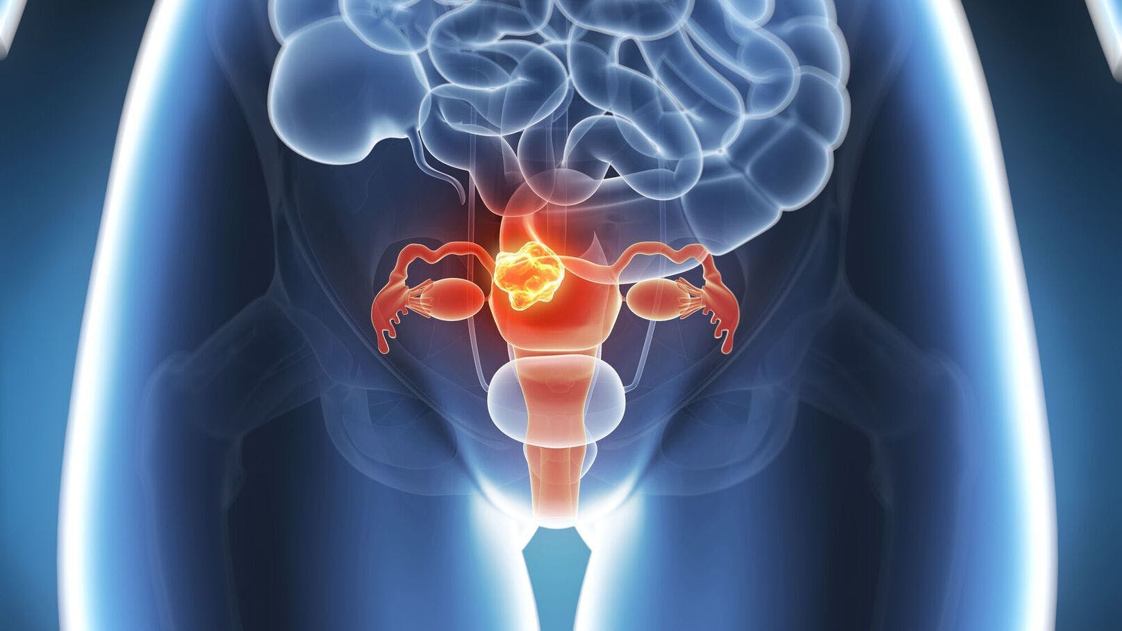 PD-L1 Warrants Further Research as Biomarker for Endometrial Cancer Therapy Response