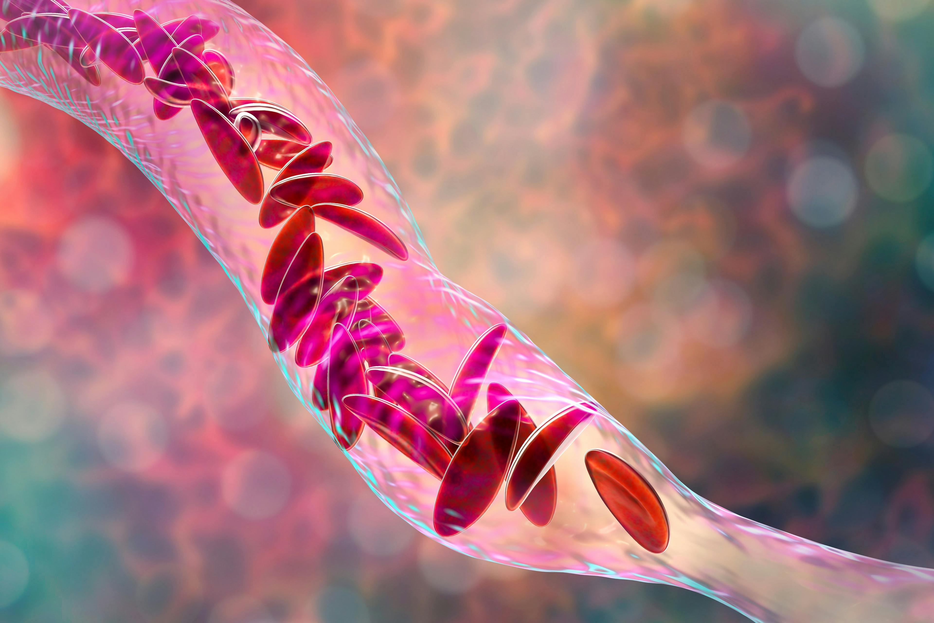 Clumps of sickle cells block the blood vessel | Image credit: Dr_Microbe - stock.adobe.com