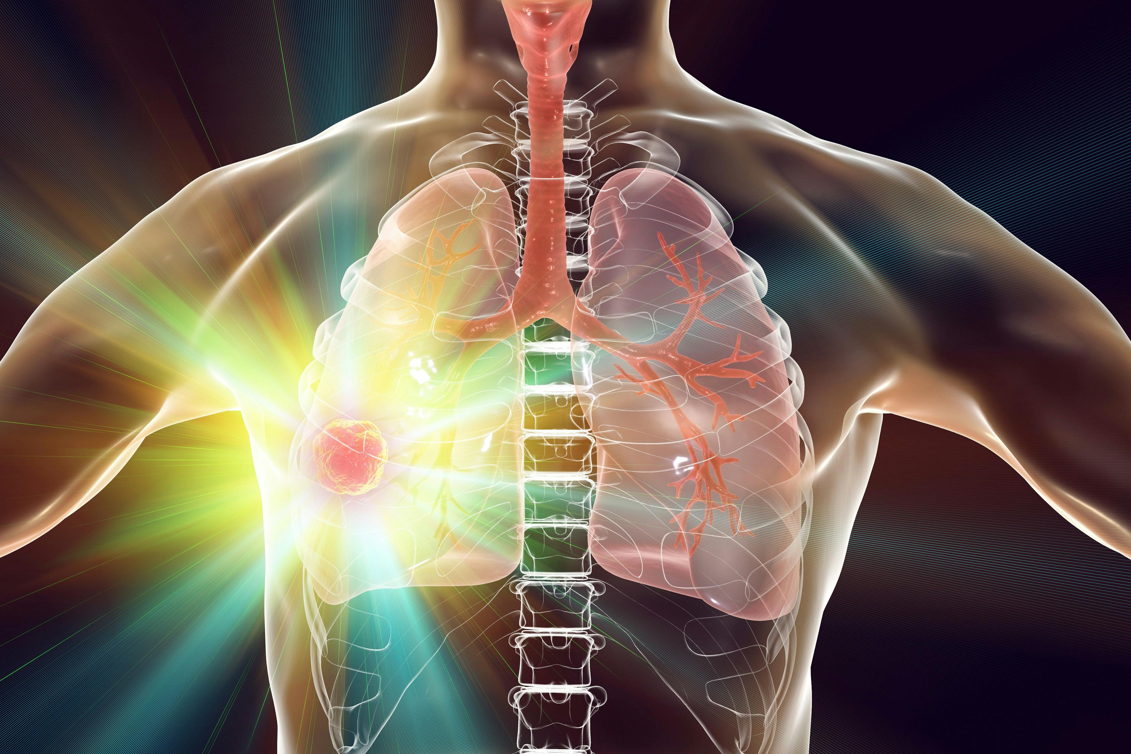 Lung cancer treatment and prevention concept | Image credit: Dr_Microbe - stock.adobe.com