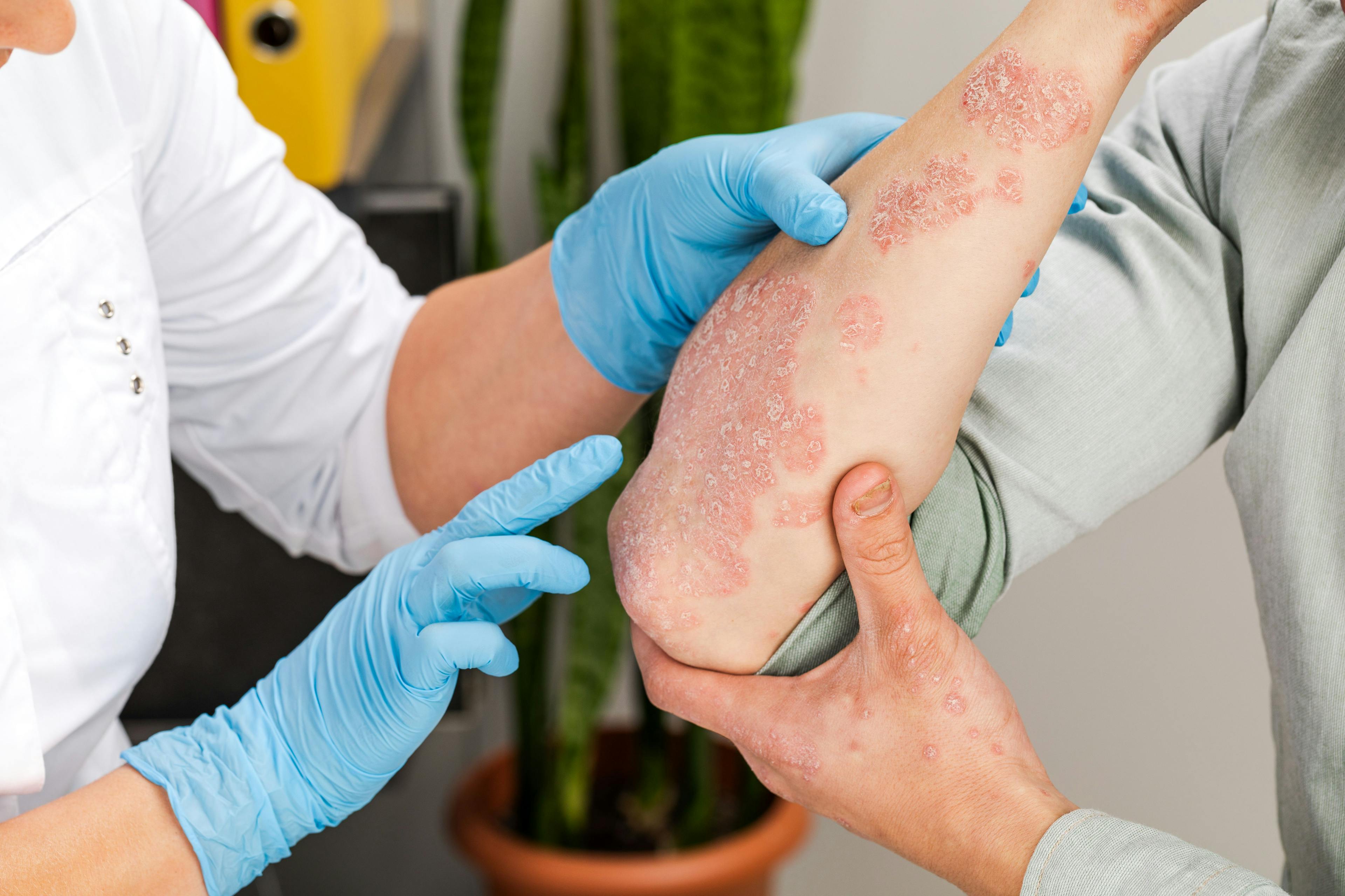 A dermatologist examines the skin of a patient with psoriasis | Image credit: © fusssergei - stock.adobe.com