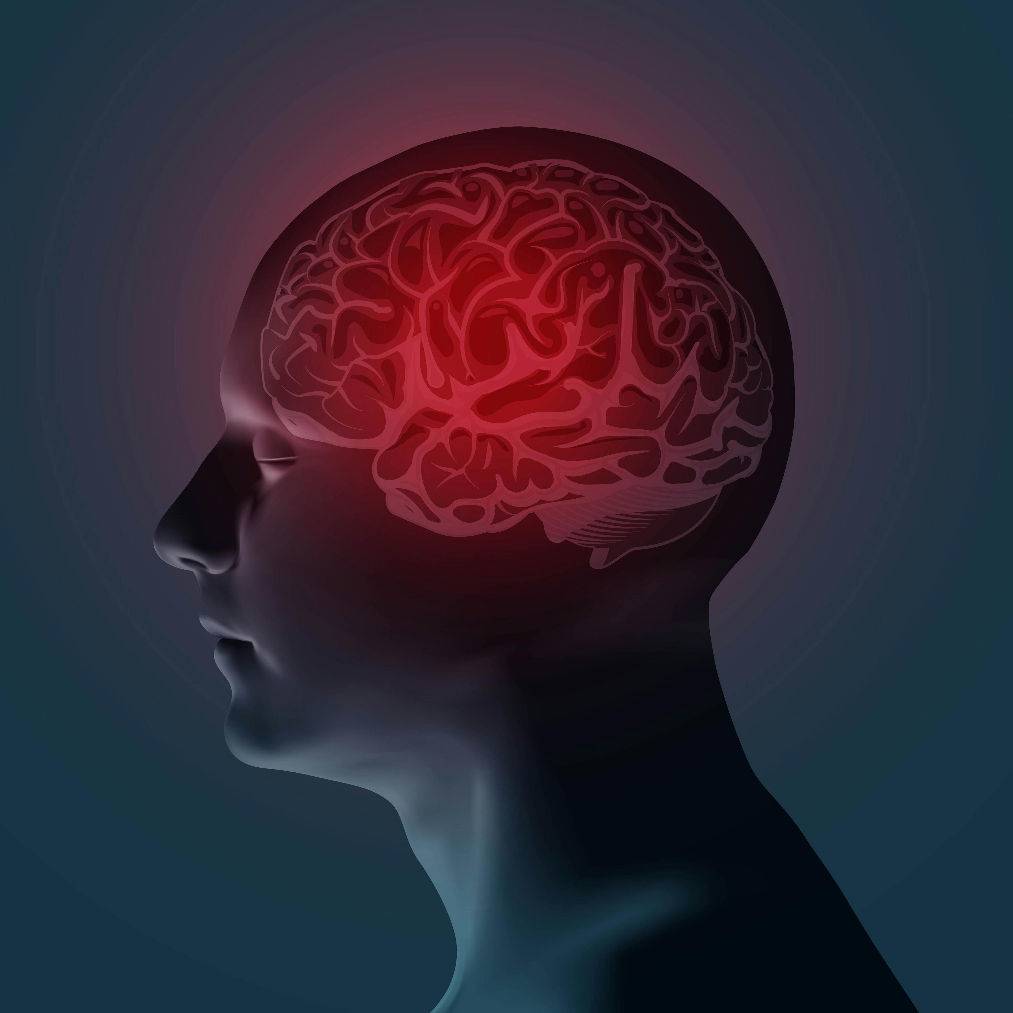 SPMS Drug Linked to Improved Cognition Processing Speed, Study Says