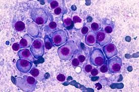 Age, Infection, Cardiac Disease Linked to Early Death for Patients With Newly Diagnosed Multiple Myeloma