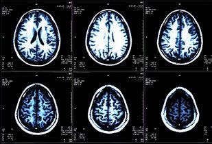 Multiple Sclerosis Remains Tricky to Identify, Diagnose