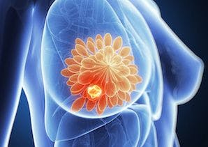 Atezolizumab Plus Chemotherapy Prolongs PFS in Triple-Negative Breast Cancer