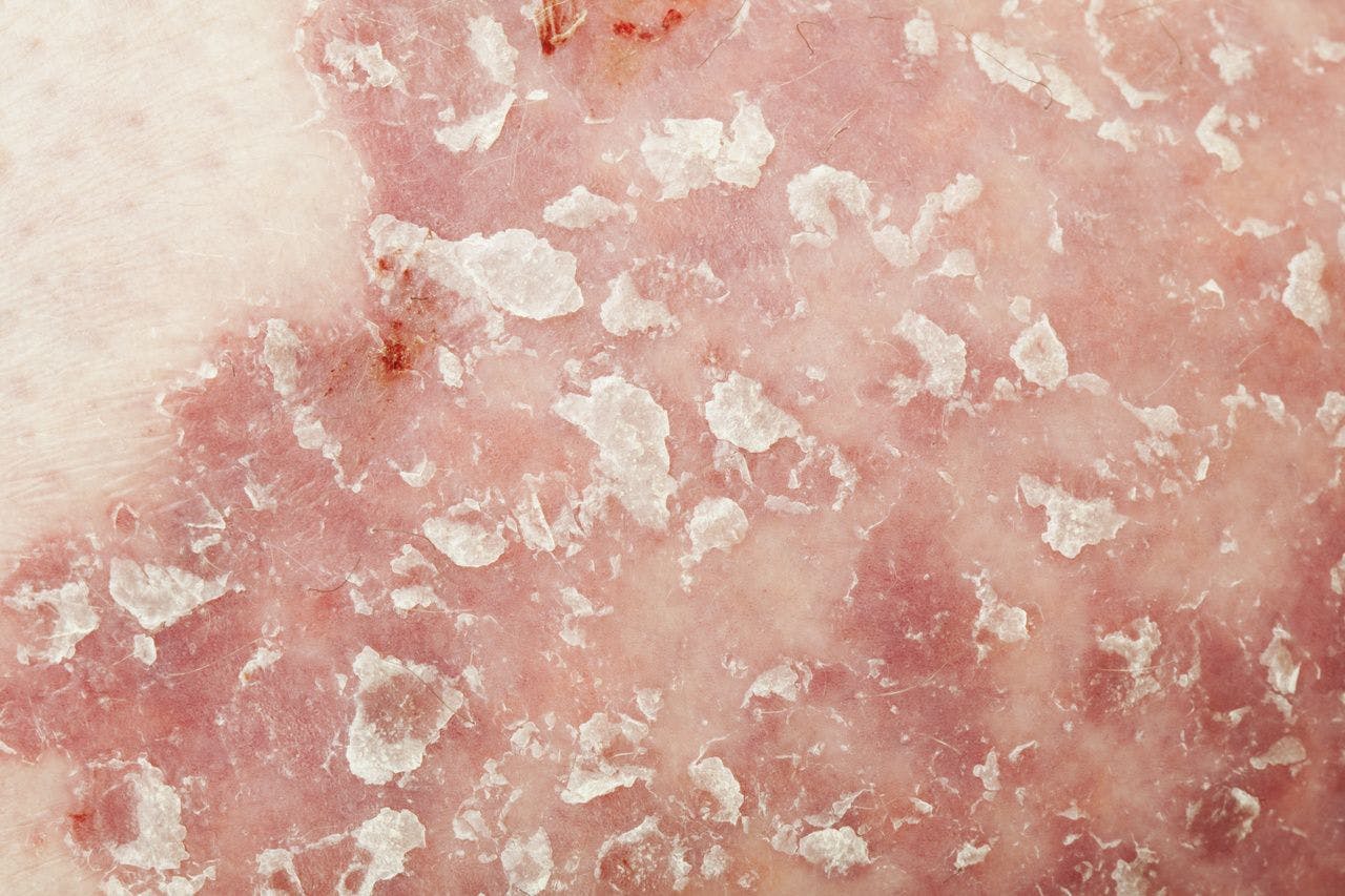 Real-World Study Examines Treatment Patterns of 2 Biologics for Psoriasis